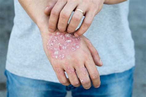 Psoriasis Vs. Eczema: What's the Difference?: Specialists In Dermatology: