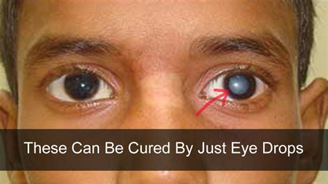 These Eye Drops Can Treat Cataract Without A Surgery