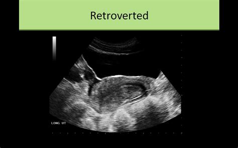 Retroverted Uterus Ultrasound Sonography Retroverted Uterus Ultrasound ...