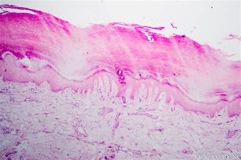 Stratified Squamous epithelium, Keratinized – Kit Ng, Ph.D.