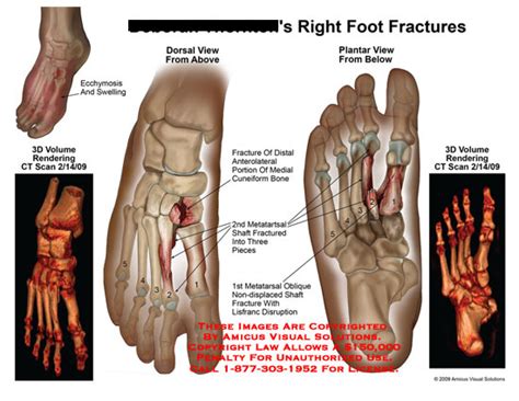 Right Foot Fractures