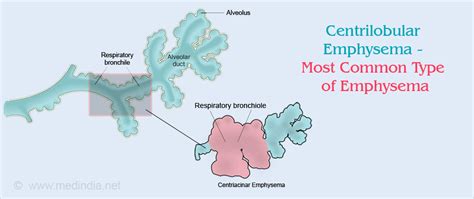 Emphysema - Causes, Types, Risk Factors, Symptoms, Diagnosis, Treatment