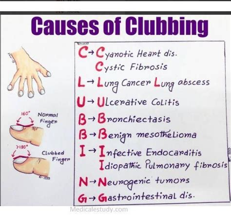 causes-of-clubbing | Idiopathic pulmonary fibrosis, Nursing school tips, Clubbing