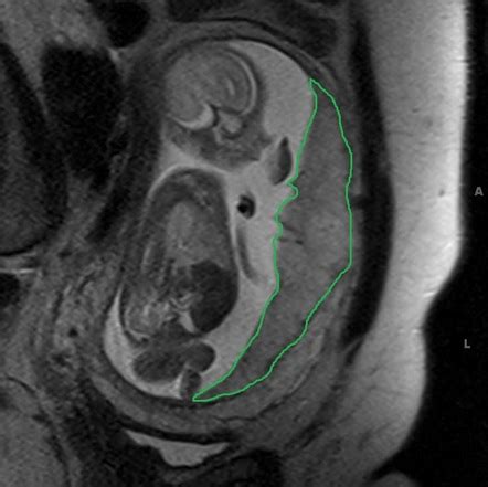 Placenta Accreta Mri