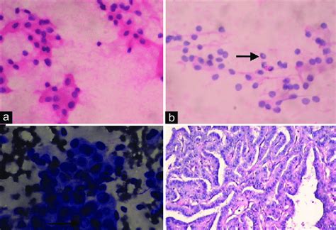 (a) FNAC thyroid showing follicular cells arranged in sheets with few ...