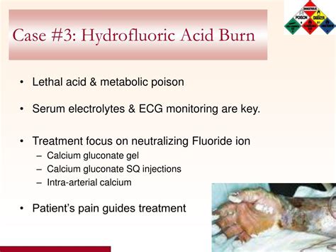 PPT - Chemical Burns PowerPoint Presentation - ID:590440