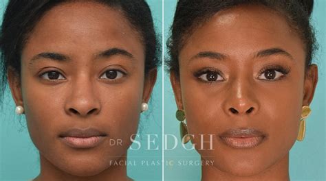 African American Rhinoplasty Before & After | Dr. Sedgh