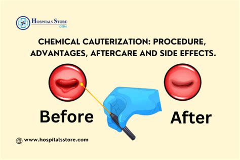 Chemical Cauterization: Procedure, Advantages, Aftercare and Side Effects.