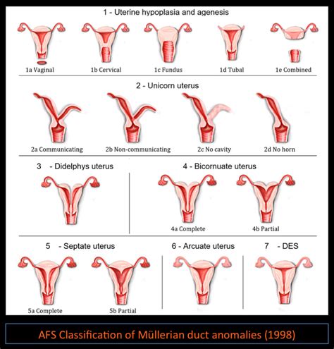 AFS Classification of Múllerian duct anomalies | Download Scientific Diagram