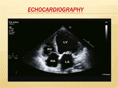 Peripartum cardiomyopathy