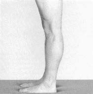 Osgood-Schlatter Disease