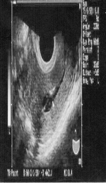 Comparison of Sonohysterography and Hysteroscopy: Lessons Learned and Avoiding Pitfalls - The ...