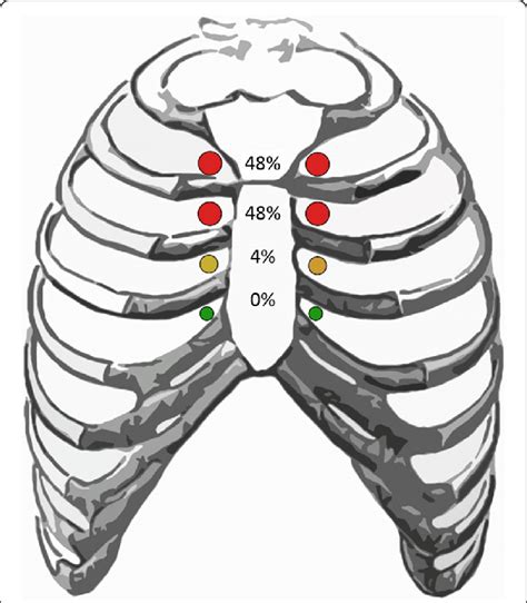 Intercostal Space Diagram