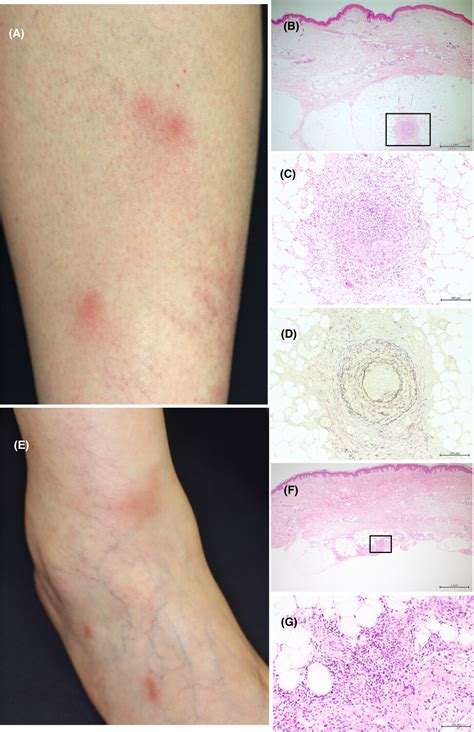 Relapsing erythema nodosum‐like eruption in a patient with ...