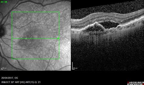 5 Macular Degeneration Facts | KindSIGHT Eye Specialists