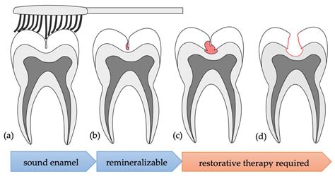 Applied Sciences | Free Full-Text | Differentiation of Occlusal Discolorations and Carious ...