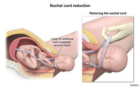 Nuchal Cord Reduction — Cote Illustration