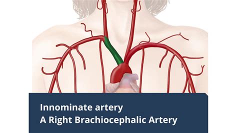 Innominate Artery- A Right Brachiocephalic Artery - Daily Medicos