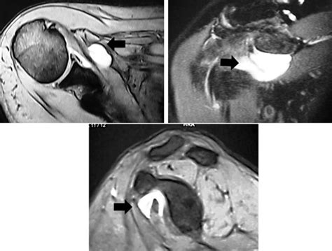 MRI of adhesive capsulitis of the shoulder: Distension of the bursa in the superior ...