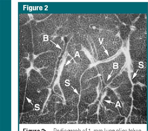 Thin-section CT of the secondary pulmonary lobule: anatomy and the ...