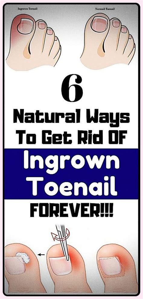 Home remedies for ingrown toenail - lockerbro