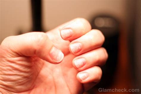 Cracked Nails : Causes, Symptoms & Treatment