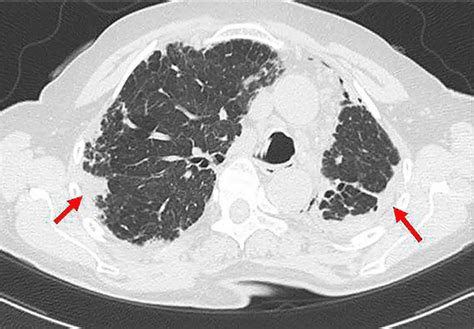 Acute interstitial pneumonitis causes, symptoms, diagnosis, treatment ...