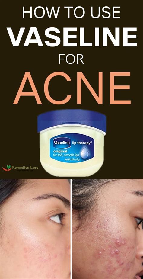 Pin by Jasmine on tips | Face acne, Vaseline uses, Vaseline uses for face