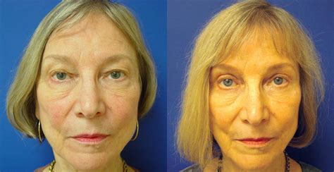 Eyelid Surgery Before & After Photos Patient 91 | San Francisco, CA ...