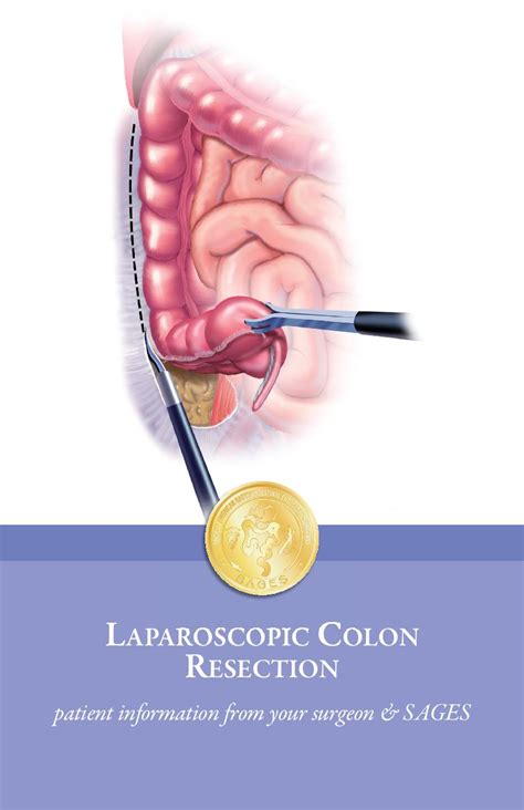 Laparoscopic Colon Resection Patient Information from SAGES