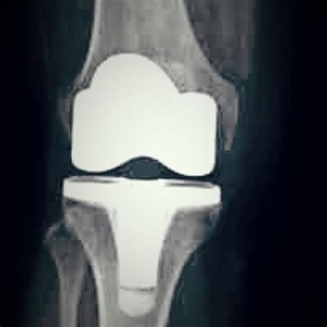 Periprosthetic Joint Infection Case Study: #AAOS Clinical Practice Guidelines ...