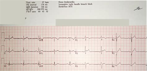 Dr. Smith's ECG Blog: RSR' with ST elevation: is this Right Bundle ...