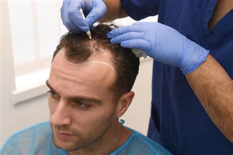 10 Best Hair Transplant Clinics in Turkey in 2022