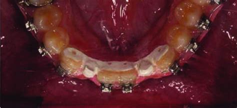 Produced modified lingual retainer adhered to the lingual surfaces of... | Download Scientific ...