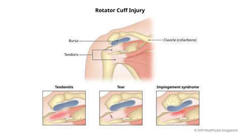 Rotator Cuff Tears & Injury - Symptoms & Causes | Parkway East Hospital