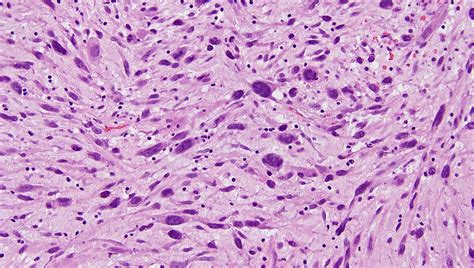 Sarcomatoid Carcinoma of the Lung