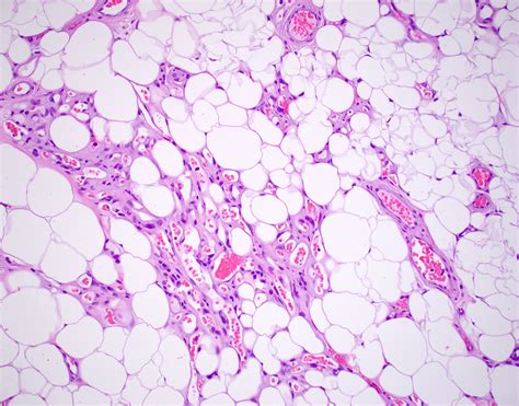 Pathology Outlines - Angiolipoma