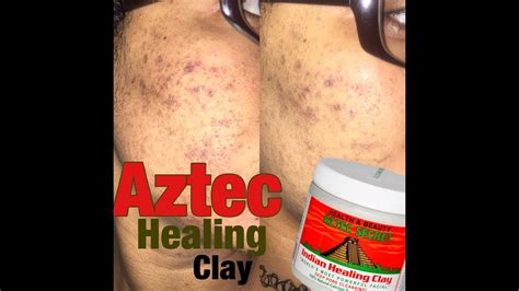 Aztec Secret Healing Clay + Acne Skin Care Regimen | Acne Prone Skin Care - YouTube