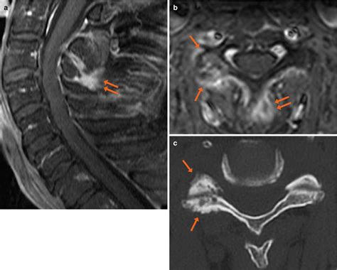 Facet Joint Osteoarthritis | Radiology Key