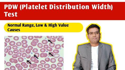 PDW (Platelet Distribution Width) Blood Test Normal Range, Low and High ...