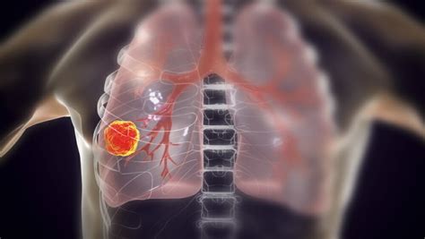 Mobocertinib Gets Breakthrough Status for NSCLC With EGFR Exon 20 ...