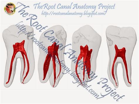 The Root Canal Anatomy Project: Mandibular First Molar (Vertucci Type IV)