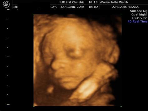 window to the womb 3d images | 3d ultrasound, Baby scan, Ultrasound pictures