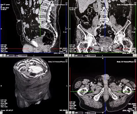 CT scan or CAT scan: How does it work?