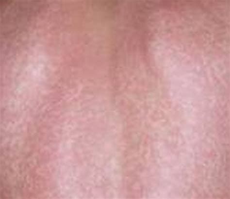 Lamictal rash – Symptoms, Treatment, Images | HubPages