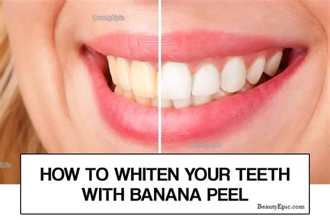 Does Banana Peel Works For Teeth Whitening? In 2024