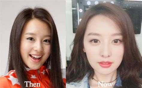 Kim Ji Won Plastic Surgery Before and After Photos - Latest Plastic ...