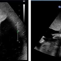 Ultrasound image of the chorioangioma before intervention. | Download ...