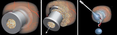 Ear Tubes May Finally Get an Upgrade | Innovation | Smithsonian