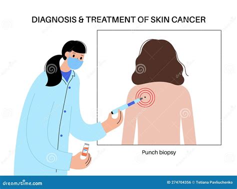 Punch biopsy procedure stock vector. Illustration of treatment - 274704356